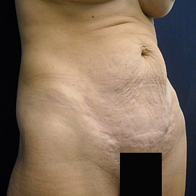 Chicago Tummy Tuck, Chicago Abdominoplasty